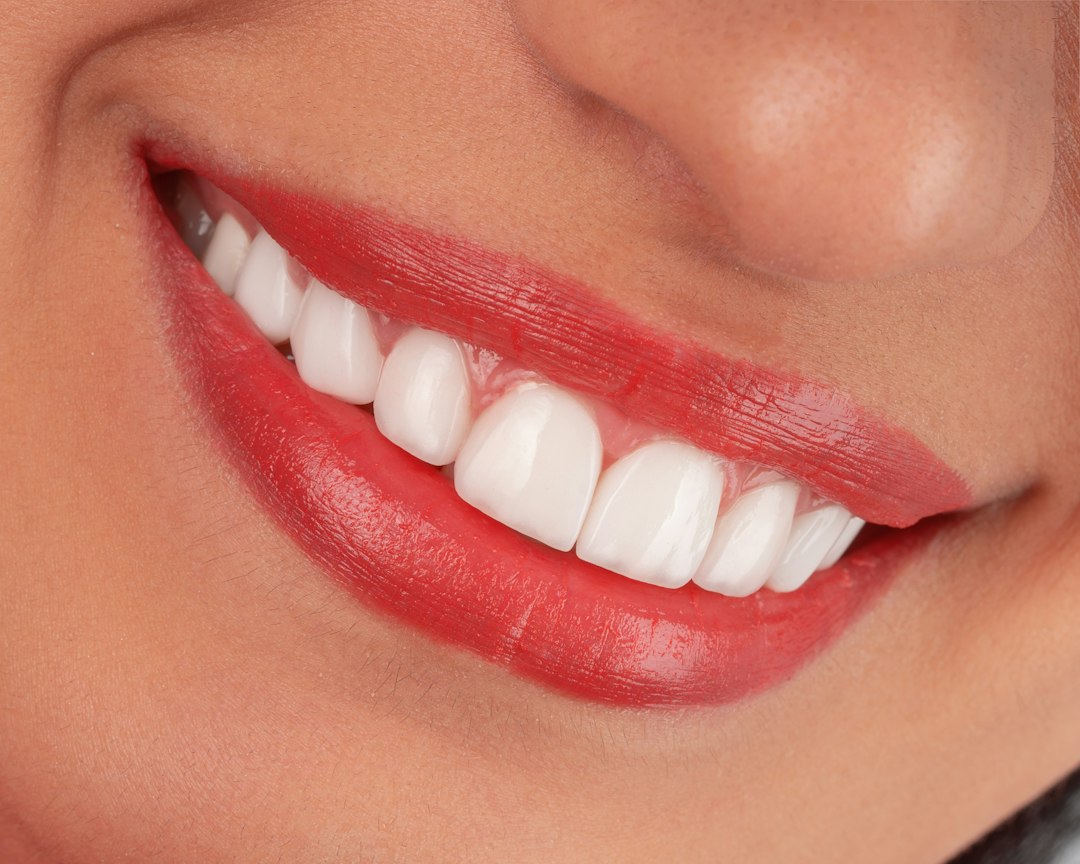 Sorriso com lentes de contato dentais de porcelana